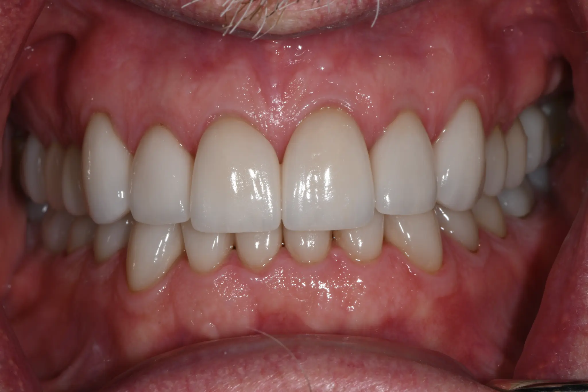 After Full Mouth Rehab