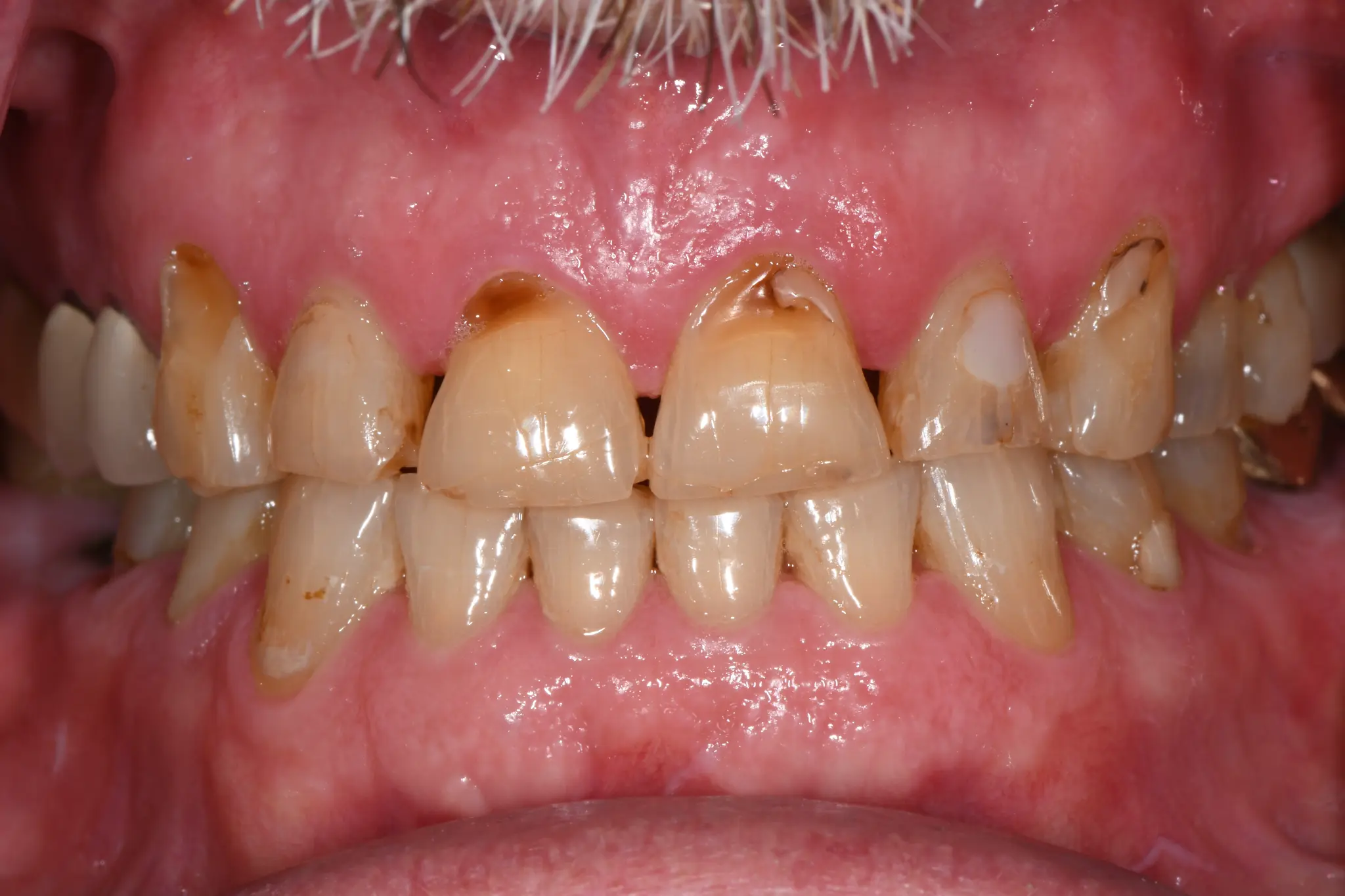 Before Full Mouth Rehab