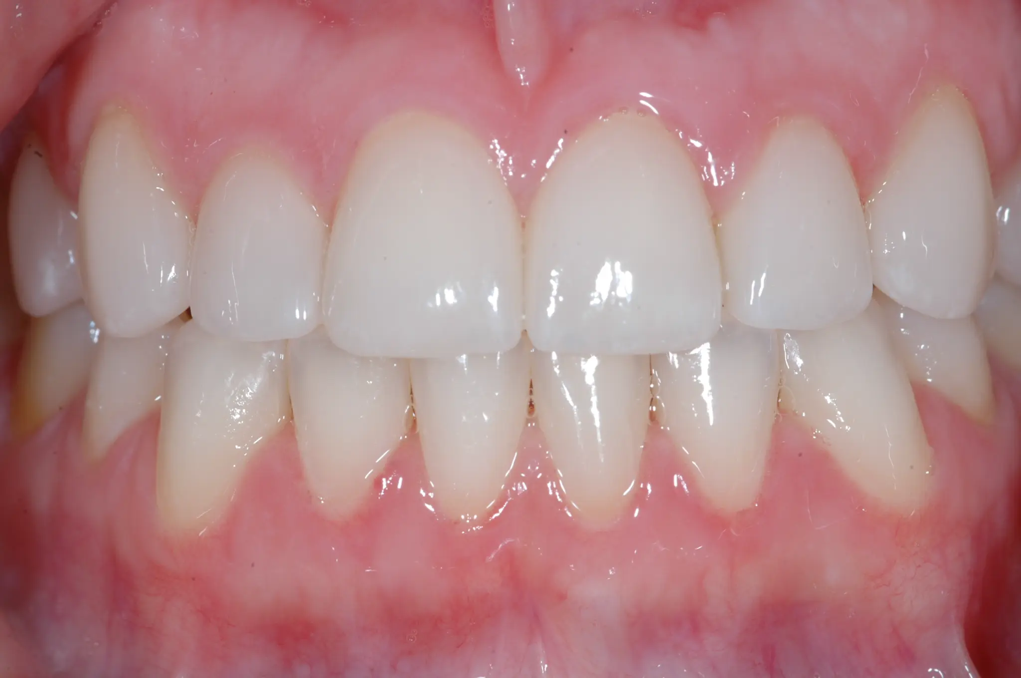 After Anterior Aesthetics