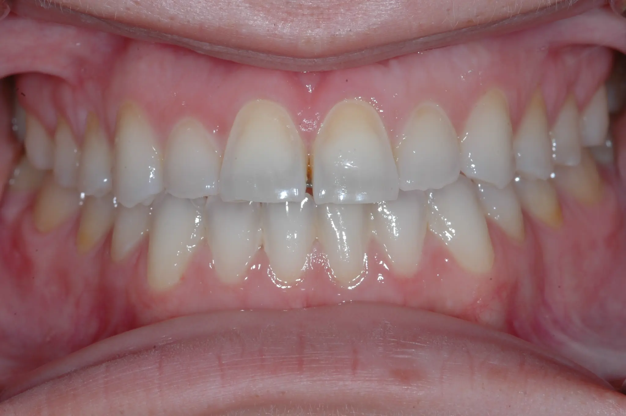 Before Anterior Aesthetics