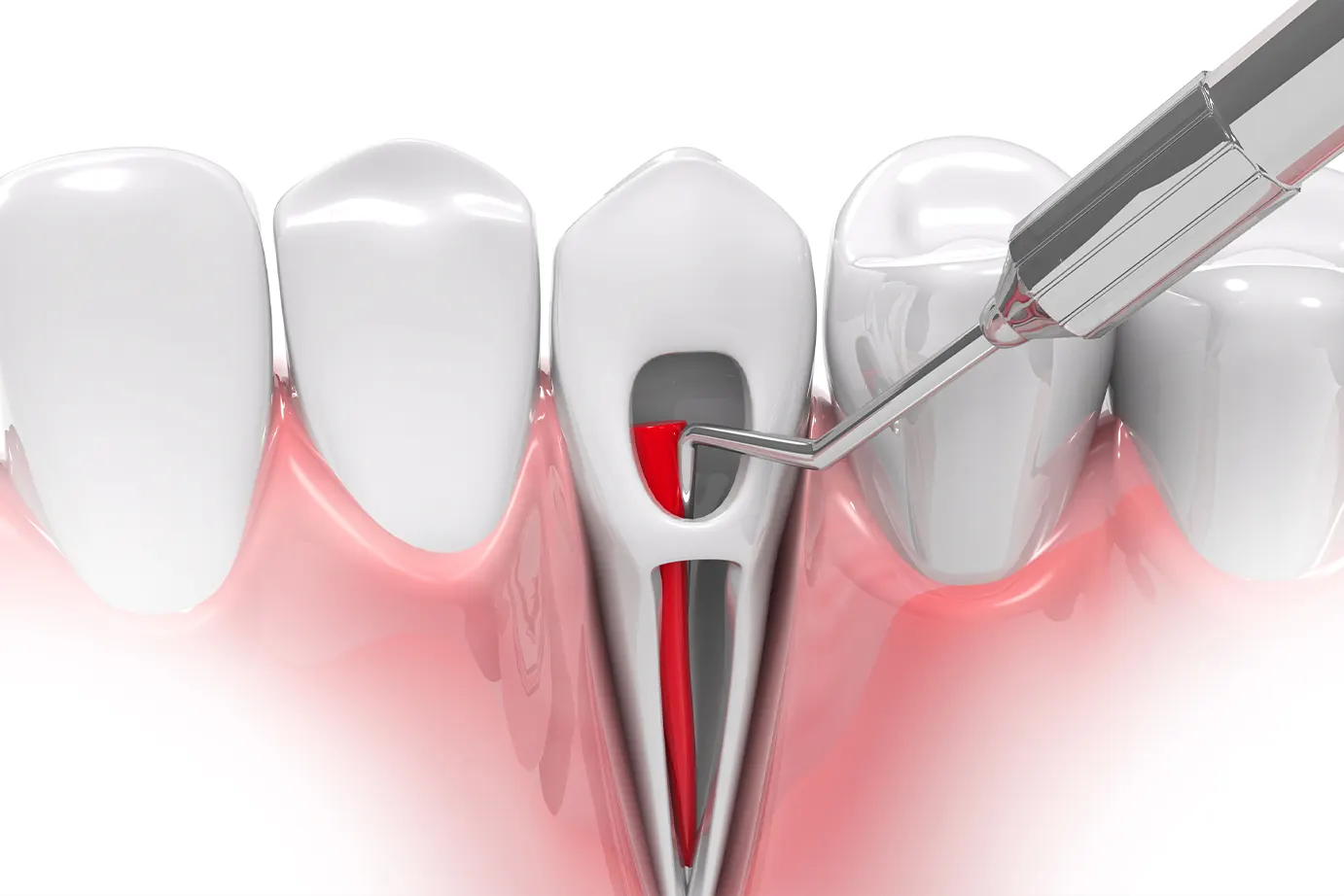 root canal therapy Schaumburg